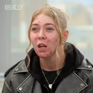 7K reactions · 71 shares | Dr Emma clears a young woman's severe acne ‍⚕️喙 #thebadskinclinic | Really Channel | Facebook