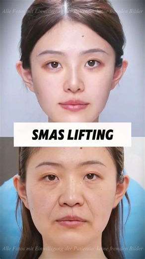 Targeted SMAS lift for jawline definition. #AestheticSurgery #faciallifting