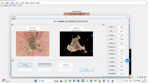 【皮肤癌检测】基于matlab GUI支持向量机SVM机器学习模型皮肤癌检测系统【含Matlab源码 14838期】