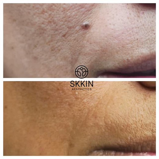 Deep blackhead extractions done safely and effectively Using professional-grade techniques to clear congestion, remove stubborn blackheads, and refine the skin’s texture — leaving it smooth, clean, and glowing. Book your deep cleanse facial at Skkin Aesthetics 📍Clayhall, IG5 www.skkinaesthetics.com | @skkinaesthetics #blackheadremoval #blackheadextraction #deepskincleansing #conjestedskin #advancedaestheticspractitioner #ilford | Skkin Aesthetics