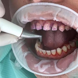 Removing biofilm before removing calculus during Guided Biofilm Therapy is the logical approach for a minimally invasive, efficient and safe treatment. It not only reduces the overall bacterial contamination, but also drastically reduces the over instrumentation that clinicians unknowingly do using conventional hand instruments and ultrasonics. In addition removing biofilm before calculus, helps clinicians to visualize the supra gingival calculus much more clearly, hence reducing the use of ultr