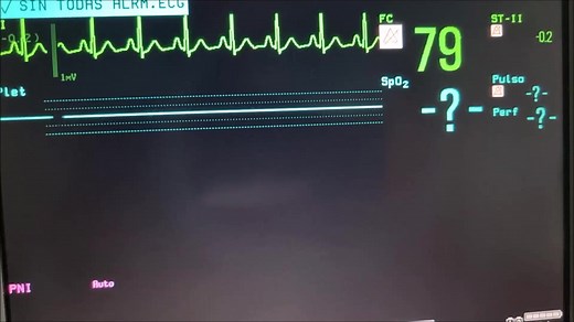 ARRITMIAS CARDÍACAS INTERPRETACIÓN DE SU PRESENCIA MEDIANTE EL PROCESO SISTEMATICO DE LAS 5 PREGUNTAS; 1. ¿Hay complejo QRS organizado? y si hay complejo QRS organizado este es angosto (menor de 0.12 segundos) y por lo tanto de origen supraventricular, o ancho (mayor de 0.12 segundos), y por tanto de origen ventricular o supraventricular con un bloqueo completo de una rama del haz de His). 2a pregunta: ¿Hay onda