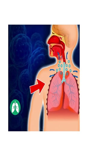 ‎Medical information // معلومات طبيّة‎ on Instagram‎: "هذه الحالة في الفيديو أعلاه هو "نفاخ تحت الجلد" أو "استرواح الجلد" أو "الإمفزيما تحت الجلدية" أو "انتفاخ تحت الجلد" Subcutaneous Emphysema؟ هو حالة يتسرب فيها الهواء من الرئة أو المجرى التنفسي إلى الأنسجة تحت الجلد، خصوصاً في منطقة الرقبة والصدر، عند الضغط على المنطقة يشعر الطبيب بـ صوت طقطقة (Crepitus) تحت الجلد، يشبه الدوس على أكياس الفقاعات. كيف يحدث؟ (الآلية المرضية) إذا حدث: - تمزق في النسيج الرئوي - ثقب في الشعب الهوائية - إصابة في جدا