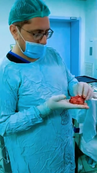 a shrunken kidney, completely filled with stones, removed during #nephrectomy #kidneystones