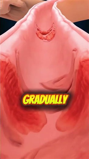 😱😱😱😱😱😱Inside the Esophagus:8K GERD & Barrett’s Transformation Ultra-Real 3D Medical Animation#facts