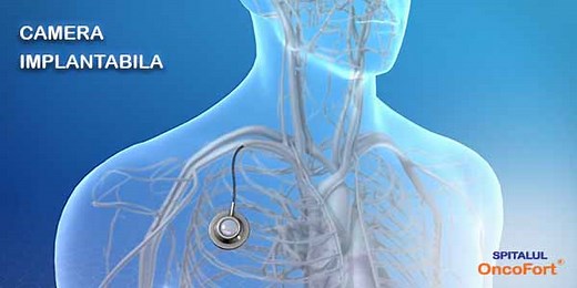 Camera implantabila - chimioterapie