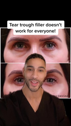 Understanding Tear Trough Filler: Treatment Options and Effects