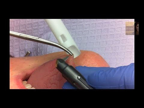 Tongue Fibroma Removed
