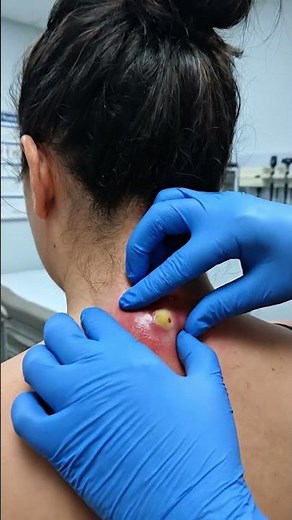 Painful Neck Abscess with Pus Drainage