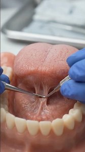 tongue Tie Release Simulation — Dental Model Procedure Demo 🦷🔍 |#shorts