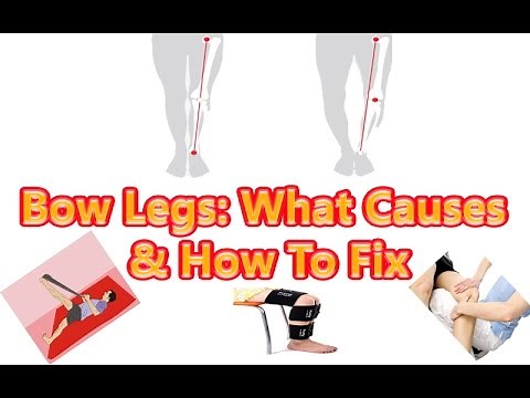 Bow Legs : What Causes How to Fix