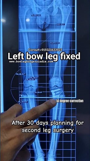 explaining about bow leg correction #bowlegs