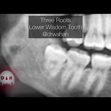 Three Roots Mandibular Wisdom Tooth Extraction. Step by Step Dental Extraction