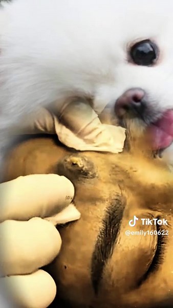 Satisfying Pimple Squeeze: Acne Blackhead Removal