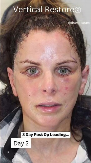 8-DAY Vertical Restore Facelift Healing & Recovery Progression!