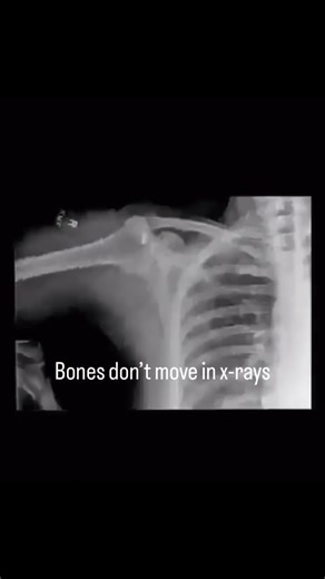 Biomedical Bits on Instagram: "Biomedical imaging 🔥 this is a dynamic x-ray (moving fluoroscopy) By capturing continuous X-ray footage during movement, clinicians can see how bones actually interact under and articulate. Key applications include diagnosing athletic injuries, to refining implant geometry, to studying real-world joint mechanics. Save for later if you’re into biomechanics, medtech, or medical imaging innovation. #biomedicalengineering #biomed #biomedicalengineer #medicine #medical