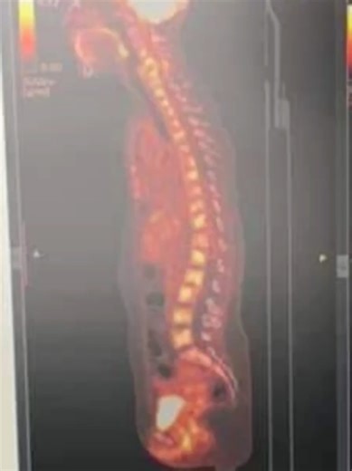 Cáncer de Mama Metastásico: Testimonio y Esperanza