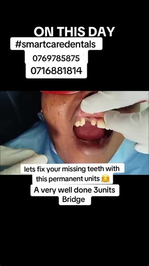 Three-Unit Permanent Bridge Construction Highlight