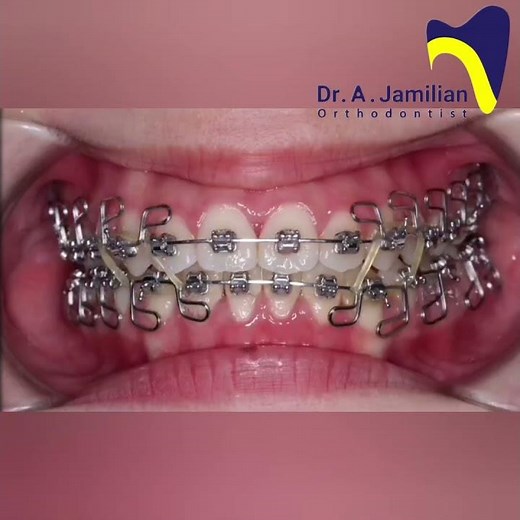 Class III Malocclusion Treatment with Fixed Orthodontic Appliances | Before & After Results #braces