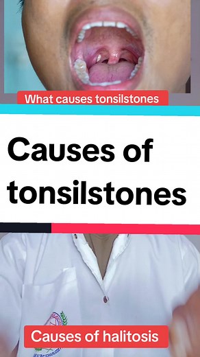 Causes of Tonsil Stones: Poor Oral Hygiene, Chronic Tonsillitis, and More