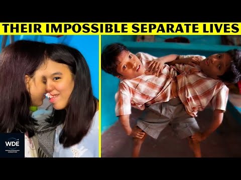 15 Most UNUSUAL Conjoined Twins & Their IMPOSSIBLE Separate Lives