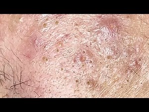 Acne Treatment New 2025 | Blackheads & Whiteheads Removal 4k