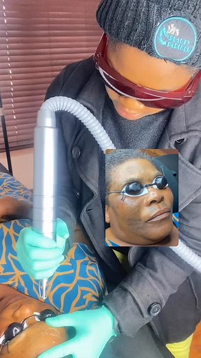 Face Tattoo Removal on our client from Vosloorus 👌Tattoo Removal Service available and done by a professional so worry not about scarring cuz we understand the assignment. Whatsapp 0835330545 to send pics of your tattoo and get a quote. Sleek and Portable Laser Tattoo Removal Machines Available for Sale @R17999 accompanied by a FREE Professional Training. 📍66 CHAPMAN ROAD, LAMBTON, GERMISTON,JOHANNESBURG,SOUTH AFRICA. 🇿🇦 | MJ's Beauty Parlour