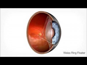 Animation Laser Vitreolysis | Lotus Vision