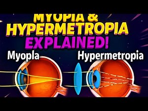 Myopia and hypermetropia with ray diagrams.8 marks guarantee
