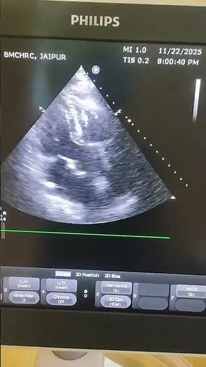 2D echo. 5 chamber view. can you see the coronaries? #heart #2decho #heartecho #cardiovisual