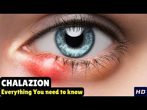 Chalazion – Causes, Signs and Symptoms, & Best Treatments
