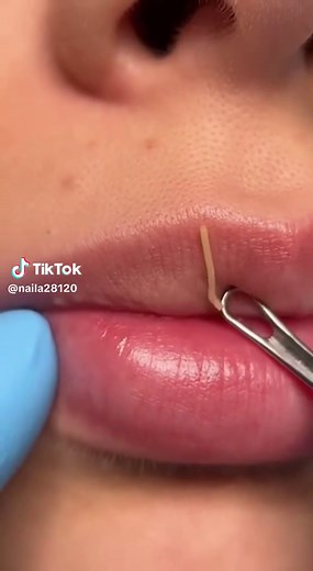 Effective Blackhead Removal Techniques for Lips