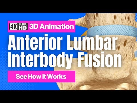 Anterior Lumbar Interbody Fusion (ALIF) - See How It Works - 3D Animation