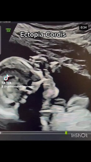 3K views · 70 reactions | Ectopia Cordis | Cardiologia/Terapia intensiva. | Facebook