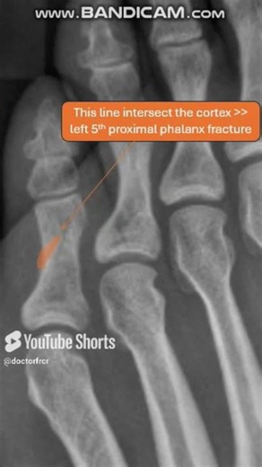 Proximal phalanx fracture 🦶