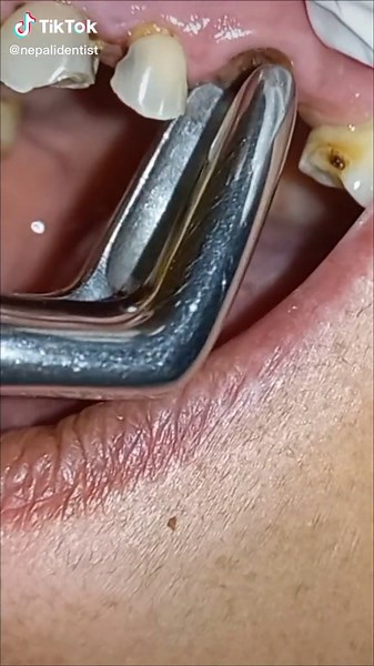 Tooth Root Removal Process Explained