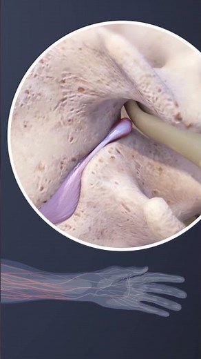 Cervical Radiculopathy