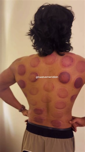 Ever wondered why cupping leaves these marks? | Twelve Meridian | Cupping Therapy