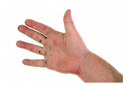 Preventing Blisters In Golf: Effective Tips And Causes