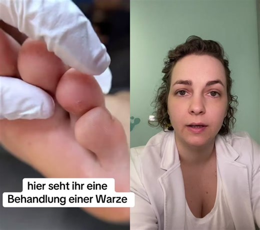 Effective Wart Treatment and Removal Techniques