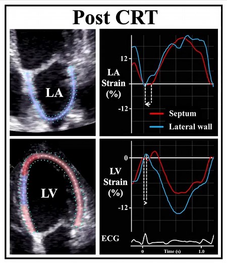 156K views · 729 reactions | Cardiac harmony through left atrial-left ventricular synchrony? Prospective multicenter study of dyssynchronous heart failure reveals mechanisms for left atrial (LA) dyssynchrony in left bundle branch block and the role LA strain assessment plays in response to cardiac resynchronization therapy. Learn more in #JACCIMG: https://bit.ly/42BwEyC | JACC Journals | Facebook