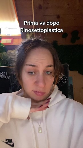 Before vs After Septoplasty | Prima vs dopo