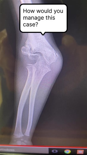 Cubitus valgus deformity following malunited laterl condyle fracture of humerus #orthopedics #OrthopedicSurgeon #healthylifestyle | Dr. Ananda Adhikari