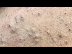 The Ultimate Facial Care Routine For Blackheads ! Deep Cleansing And Blackhead Removal.