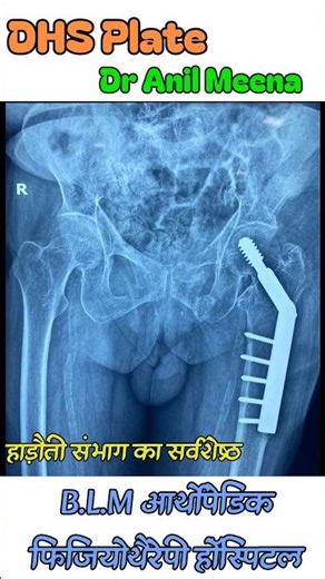 hip joint fracture recovery time | hip fracture healing time | hip joint fracture exercises | shorts