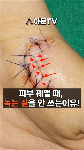피부를 봉합 할 때는 왜 녹는실을 사용하지 않나요?(성형외과 피부 봉합 수술 실밥 녹는실 상처 출혈 흉터 레이저)[아문TV]