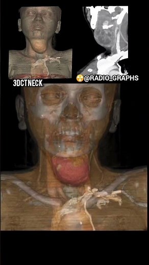 3DCT NECK Thyroid cyst #ctscan #xray #mri #radiology #radiographer #technology #study #angiography