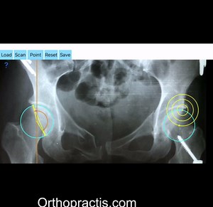 how to measure acetabular anteversion from simple xrays