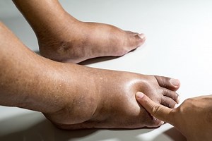 Edema: definition, causes, symptoms, diagnosis and treatment