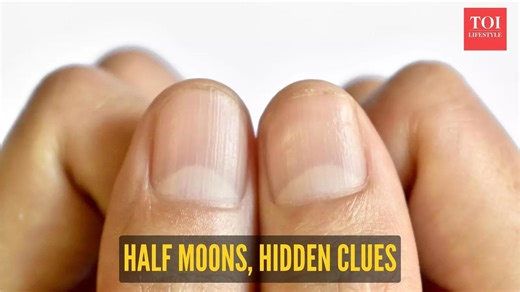 Is the formation of a half moon on the nail a symptom of heart or kidney disease?